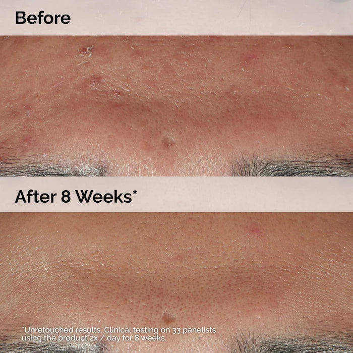 The Ordinary  Niacinamide 10% + Zinc 1% Oil Control Serum