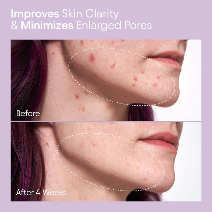 ALPYN  2% BHA Pore Perfecting Liquid Exfoliator for Brighter & Clearer Skin