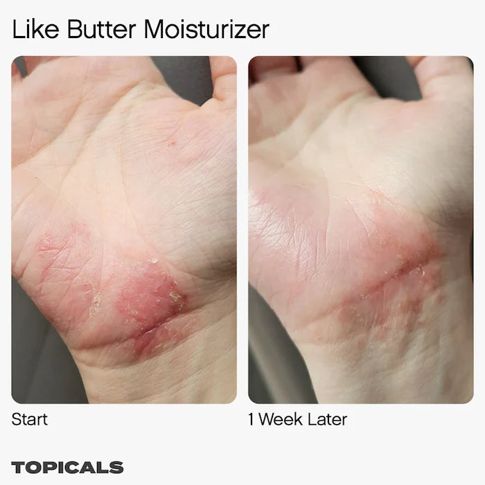 Topicals  Like Butter Moisturizer for Dry, Sensitive & Eczema-Prone Skin