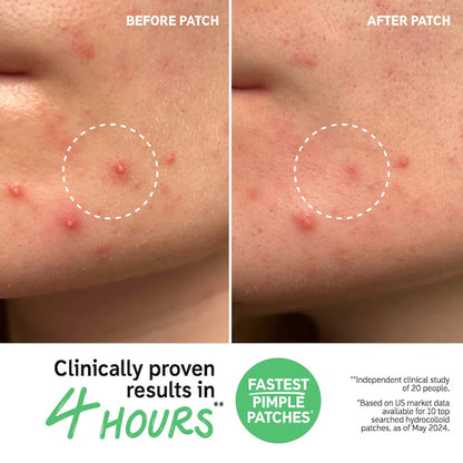 The INKEY List  Hydrocolloid Invisible Pimple Patches + Salicylic Acid
