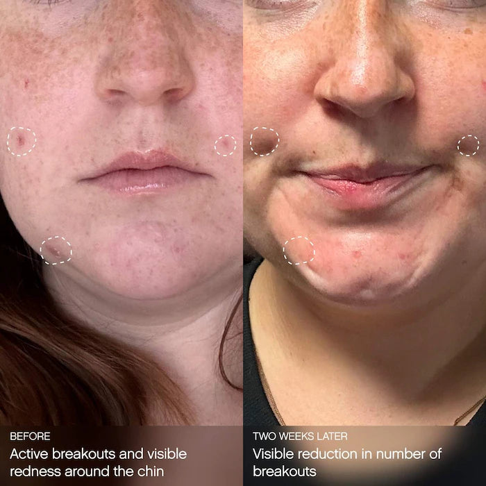 Topicals  Clearly Clarifying & Calming Mask For Breakout-Prone Skin