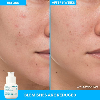 innisfree  Gentle Retinol Salicylic Acne Serum