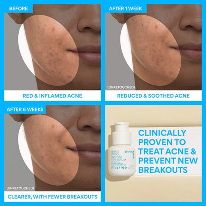 innisfree  Gentle Retinol Salicylic Acne Serum