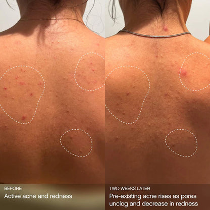 Topicals  Clearly Clarifying & Calming Mist For Acne-Prone Skin