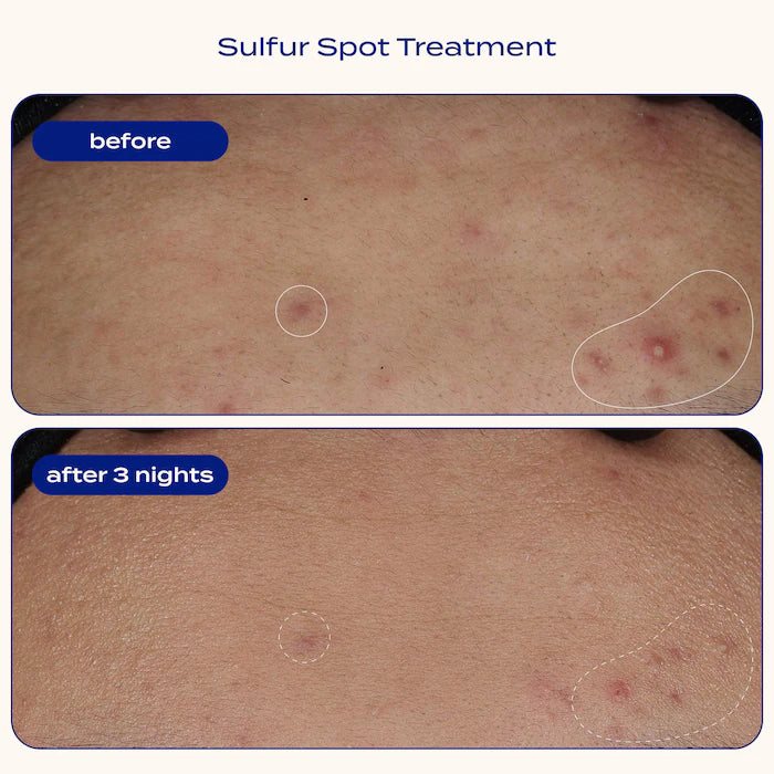 banu  Sulfur Spot Treatment for Acne and Blemishes