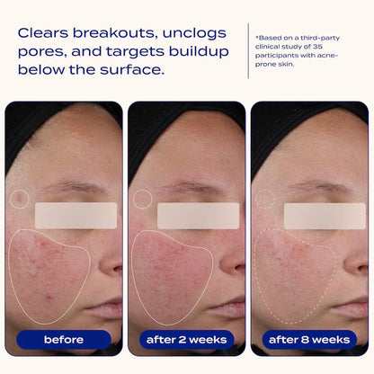 banu  AHA + BHA Blemish Clearing and Exfoliating Serum with 2% Salicylic Acid